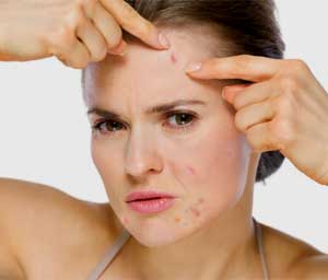 How Hormones Cause Adult Acne in Women